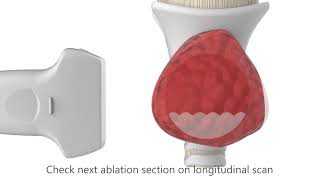Rf Medical - Radiofrequency Ablation Of Thyroid Nodules - 3D Animation Video