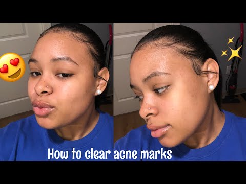 How To Get Clear Skin & Rid Of Acne Scars