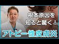 【知ると驚愕】なぜアトピー性皮膚炎になるのか？