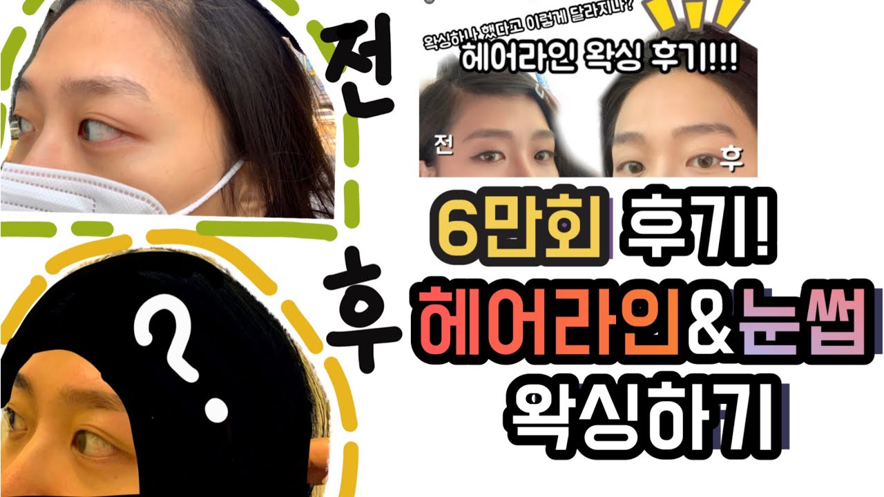 (6만회 기념)이마라인왁싱/헤어라인왁싱/눈썹왁싱/헤어라인관리/왁싱Q&A/왁싱관리/오늘도 헤어라인을 하고왔다!