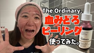 【Skincare】How to use The ordinary AHA 30% + BHA2% Peeling Solution. 血みどろピーリングを使ってみた！