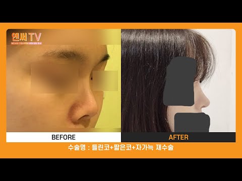 들린코 재수술 후기가 궁금하다면? l 앤써성형외과 Answer Plastic Surgery