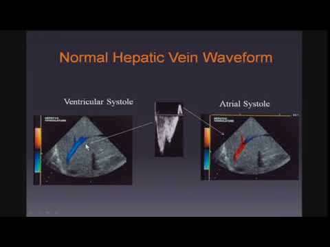 Doppler Ultrasound of the Liver and Portal Hypertension