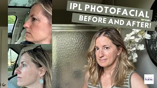 IPL Photofacial Before and After - IS IT WORTH IT?