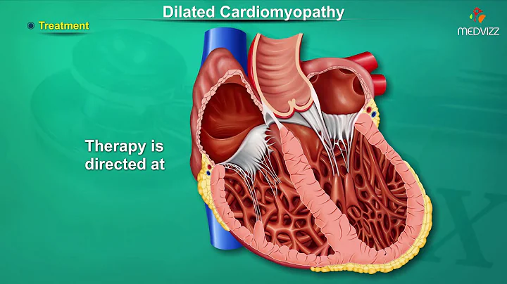 Dilated cardiomyopathy ( DCM ) : Causes, Signs and Symptoms, Pathogenesis, Diagnosis, and Treatment - DayDayNews