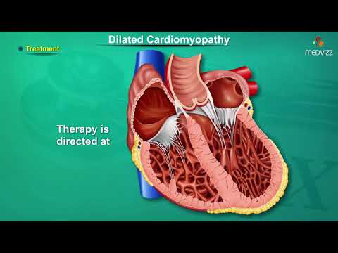 Video: Dilated Cardiomyopathy - Symptoms, Treatment, Forms, Stages, Diagnosis