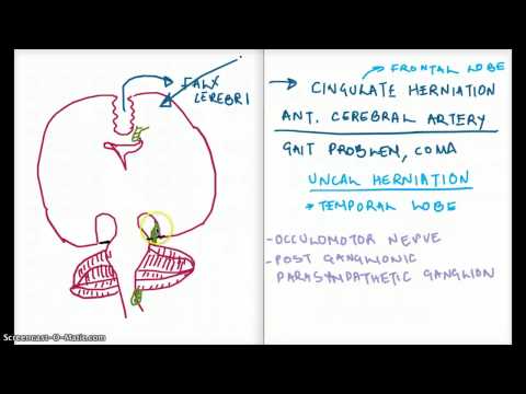 Easy Ways to Remember Cerebral Herniation