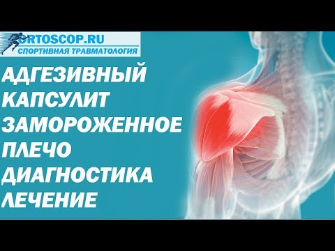 Видео: Как лечить адгезивный капсулит?