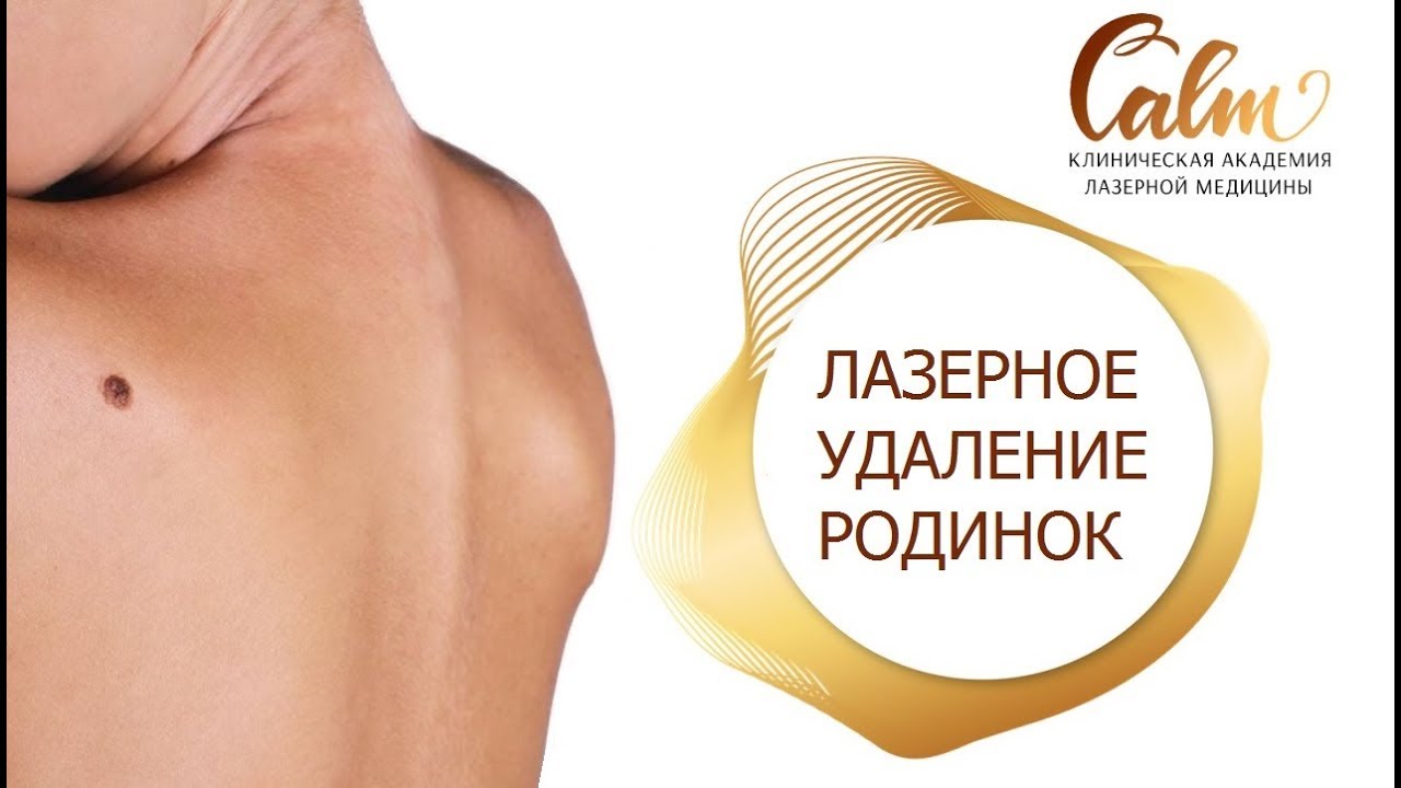 Удаление родинок киев