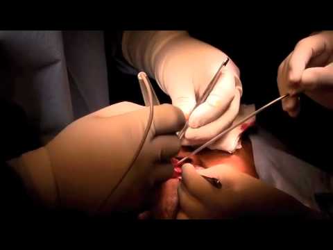 Moreano World Medical Mission: Cleft Lip Surgery Part 2