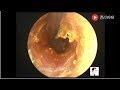 Earwax Removal Extraction.Clean the outer ear canal and the dry  on the surface of the tympanic