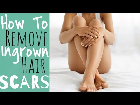 How To Remove Ingrown Hair Scars | Victoria Victoria