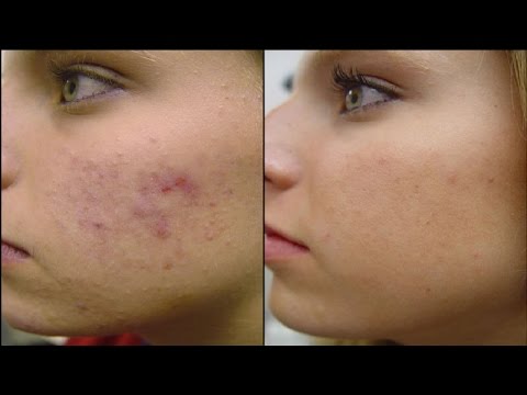 does accutane stop bone growth
