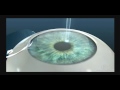 LASIK