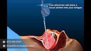 Sleep Apnea Treatment By Aspire Medical Device