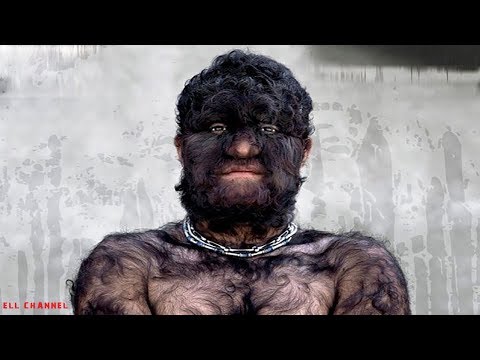 10 იშვიათი მუტაციური დაავადება, რომელიც ადამიანებში გვხვდება