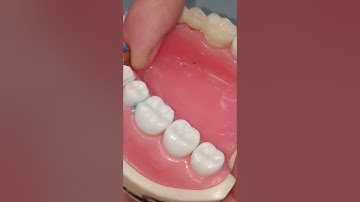 Lab 1: Protecting adjacent teeth  Part 2