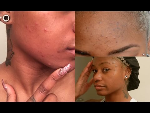 How to | Get Rid of Hyperpigmentation, Acne, Dark Spots on skin (Oily/ Combination)