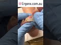Callus Removal Podiatrist Tips Unleashed Watch the Transformation #Podiatry #FootCare
