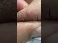 #waxing #ingrownhair #trending #hair #beard #remove #asmr #maazsafder #hairremoval #natural NK.0183