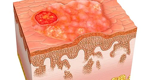 C'est quoi un carcinome Epidermoide ?