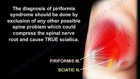 The Piriformis syndrome causes and diagnosis - Everything You Need To Know - Dr. Nabil Ebraheim
