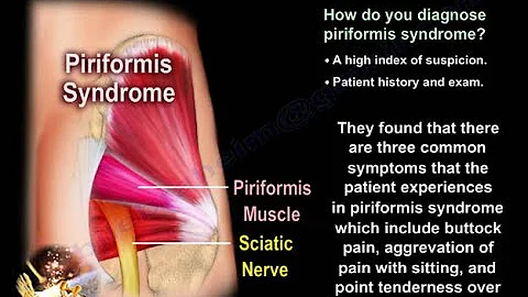 The Piriformis syndrome causes and diagnosis - Everything You Need To Know - Dr. Nabil Ebraheim - DayDayNews