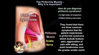 The Piriformis syndrome causes and diagnosis  Everything You Need To Know  Dr. Nabil Ebraheim