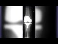 Острый гонит коленного сустава. Цементное эндопротезирование. Травматолог Станислав Бондаренко