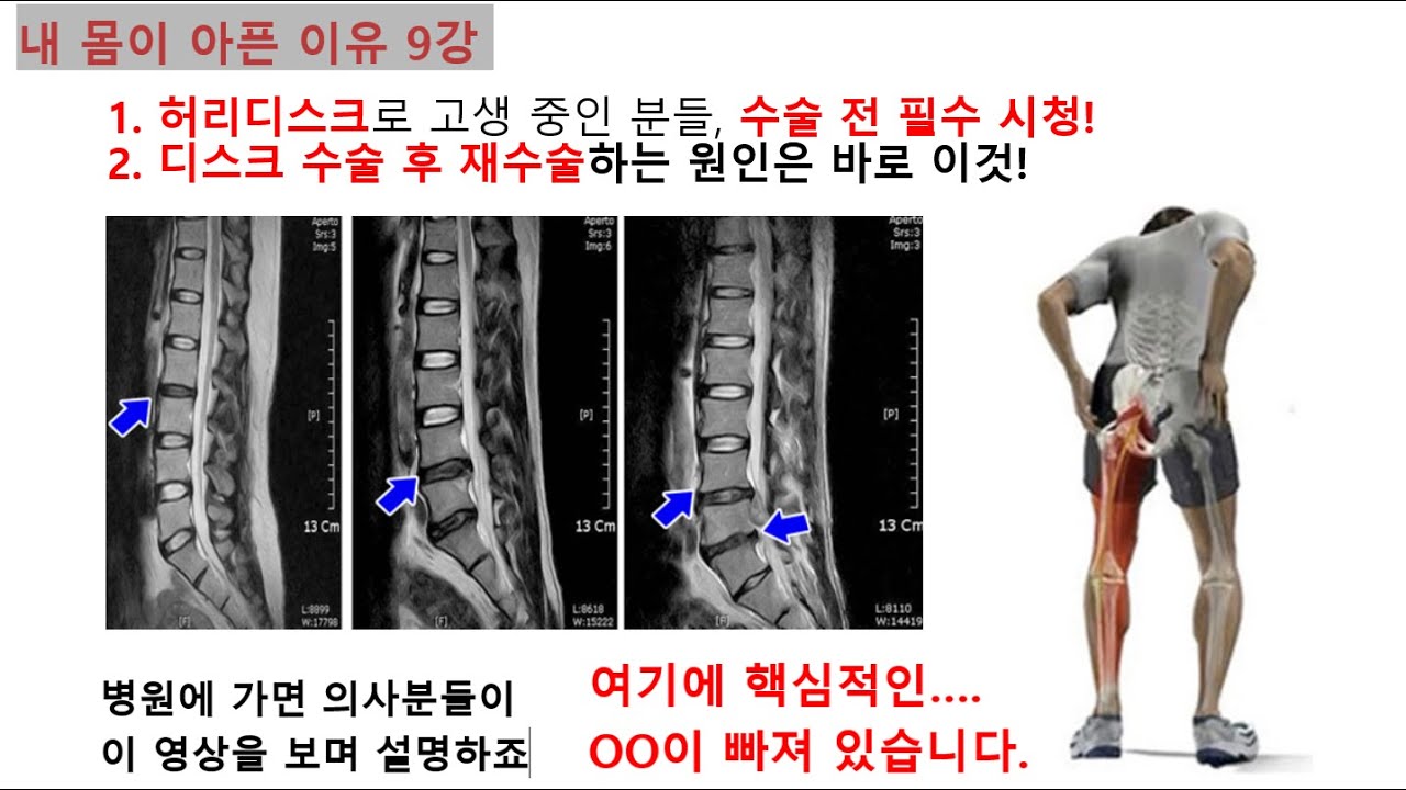 내몸이 아픈 이유 9강) 흔한 허리디스크 설명이 아닙니다. 요통, 허리디스크, 척추관협착증으로 고생하고 있다면 꼭 보시길 ...