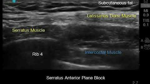 Serratus Anterior Plane Block