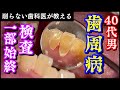 【歯周病検査一部始終】40代後半男性、歯磨きを日頃がんばっていて引き締まった歯茎に見えるが、よく見ると出血あり、歯周病あり、歯石あり、虫歯あり。歯のトラブルを抱えてます。