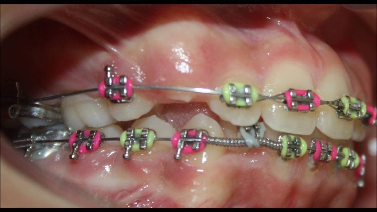 Ortodoncia Dentición Mixta - YouTube