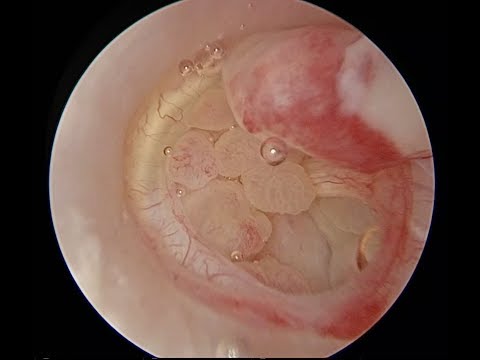 Video: Otitis Sugu (maambukizo Ya Sikio) Na Utaratibu Wa Upasuaji Tunauita TECA