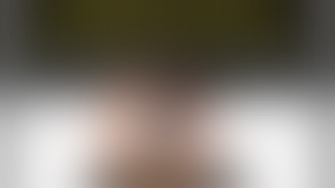 Management of Severe Subluxated IOL-BAG complex with Flanged IOL Fixation Technique. Dr Necip Kara