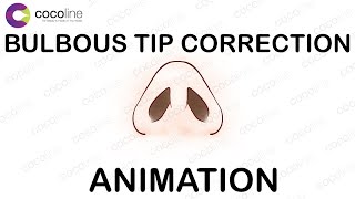 Bulbous Tip Correction: 90-Second Nose Transformation Guide - Rhinoplasty Animation from Cocoline