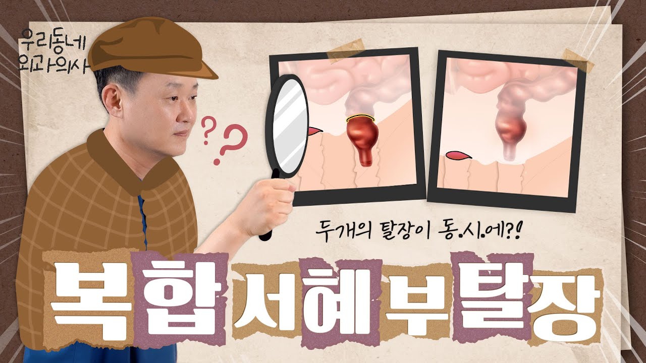 복합 서혜부탈장 (Pantaloon Hernia) - YouTube