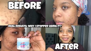 I TRIED TO GET RID OF MY HYPERPIGMENTATION | PALMERS SKIN SUCCESS