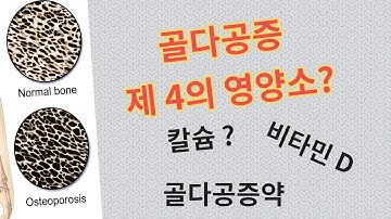 칼슘 비타민D 골다공증약을 먹어도 골밀도가 오히려 나빠지는 이유는 이 영양소 섭취 부족 때문입니다.