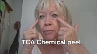 20% TCA peel