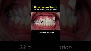 Braces transformation, fix severely crooked teeth. 23 months journey #braces #dentist #orthodontics