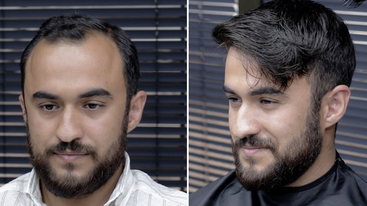 PROTEZ SAÇ UYGULAMASI - Değişim Senin Elinde! - Hair Replacement