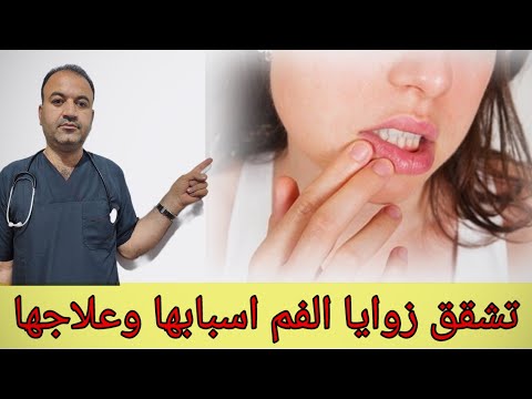 اسباب تشقق زوايا الفم وطرق علاجها