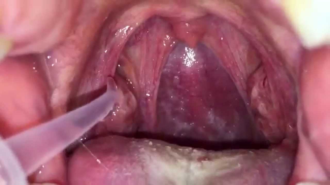 臭い玉 膿腺 の場所が動画でよくわかる 膿栓動画がヤバ過ぎ 体臭ラボサロン 消えない口臭 体臭の予防と対策
