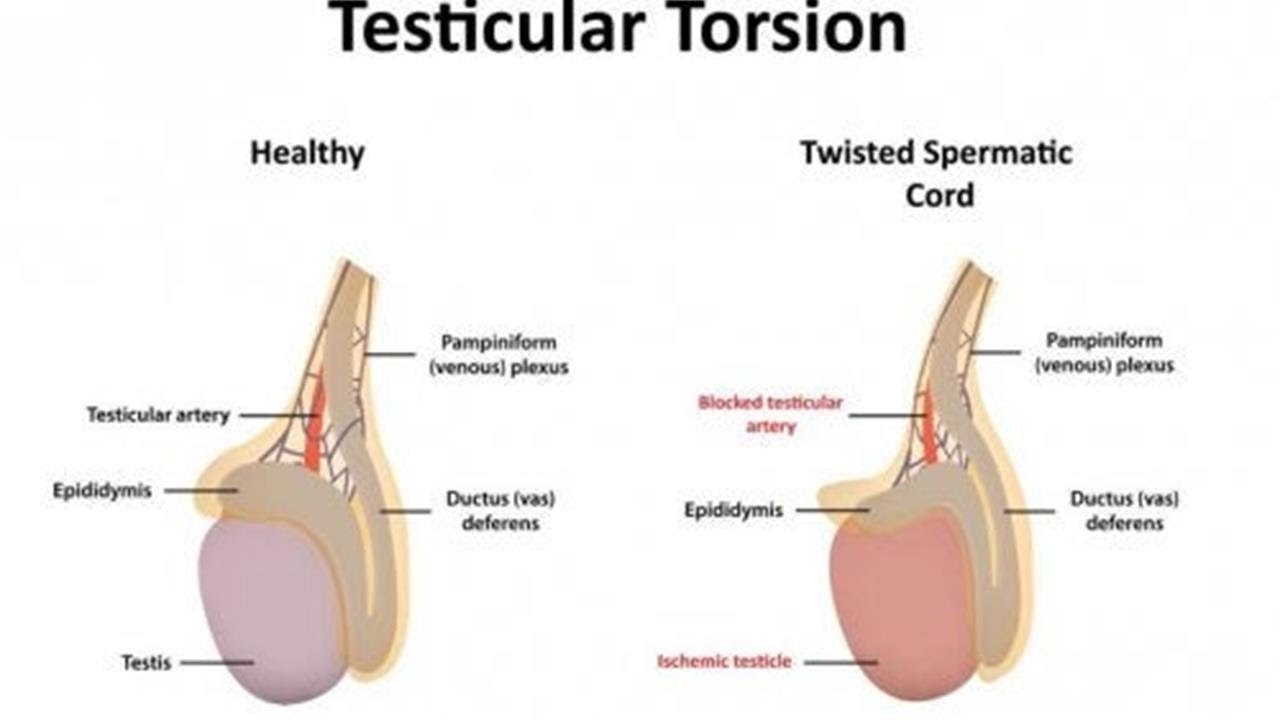 torsion