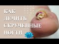 Вросший ноготь лечение коррекционной системой