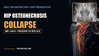 Femoral Head Osteonecrosis — Preserve or Replace?