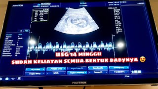 Usg Janin 14 Minggu ,Udah Keliatan Semua Bentuk Bayinya