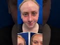 Post op Septorhinoplasty Sinus Surgery Tonsillectomy 1 week ago and very happy with result