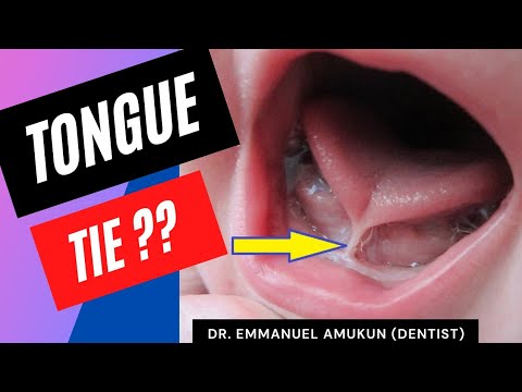 Tongue tie in Babies (Ankyloglossia) | Signs and treatment.
